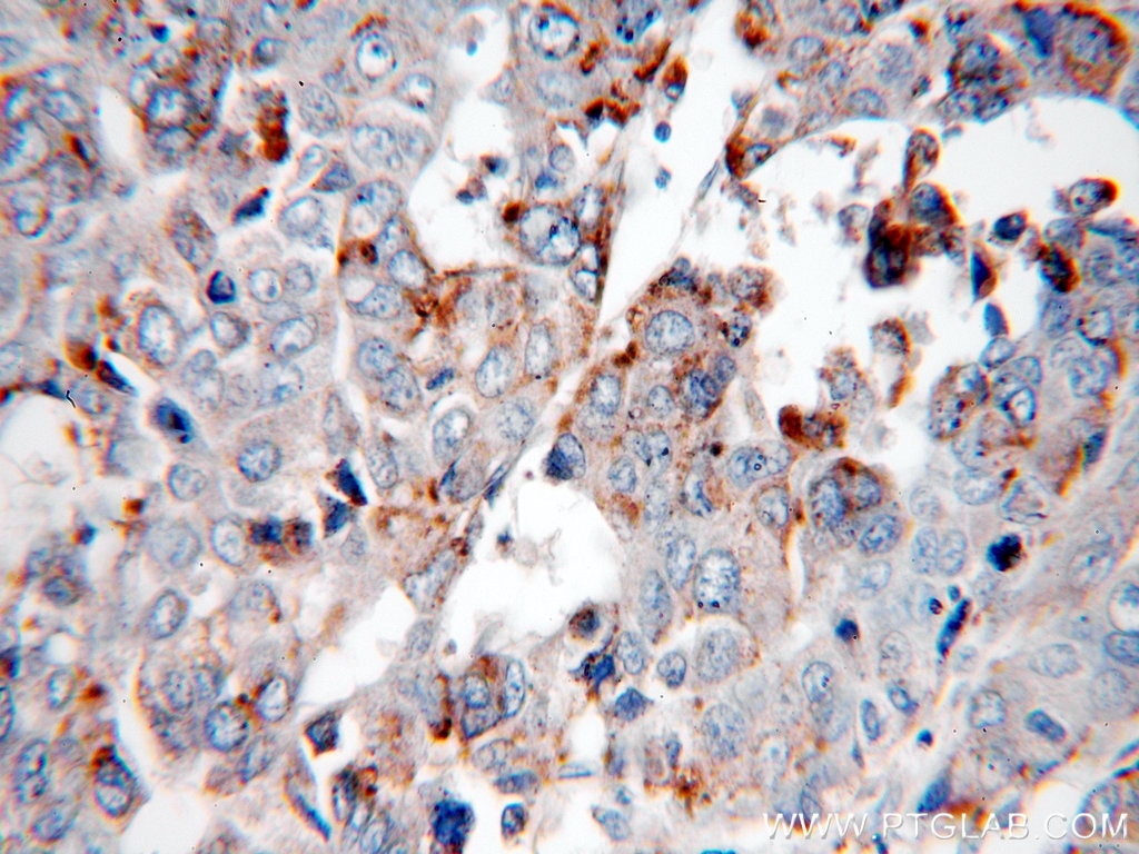 Immunohistochemistry (IHC) staining of human liver cancer tissue using PSAP Polyclonal antibody (18396-1-AP)