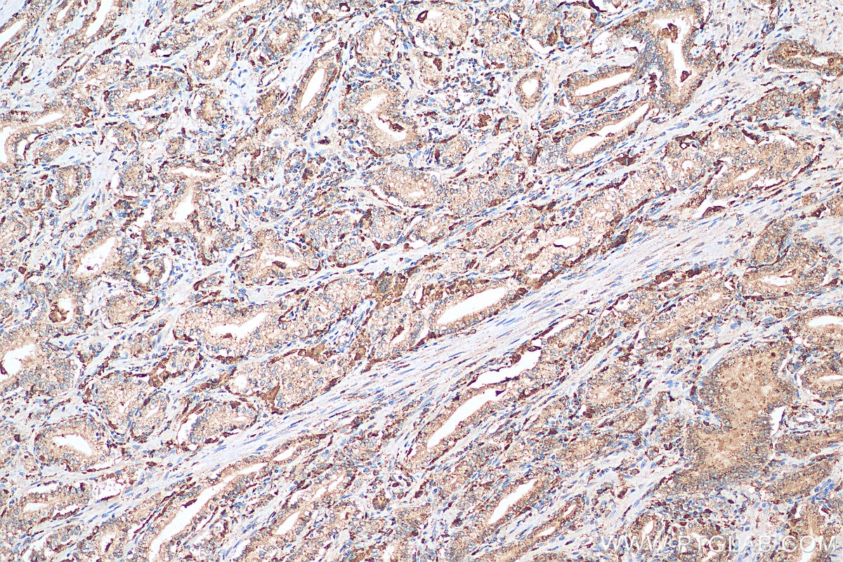 Immunohistochemistry (IHC) staining of human prostate cancer tissue using PSAP Polyclonal antibody (18397-1-AP)