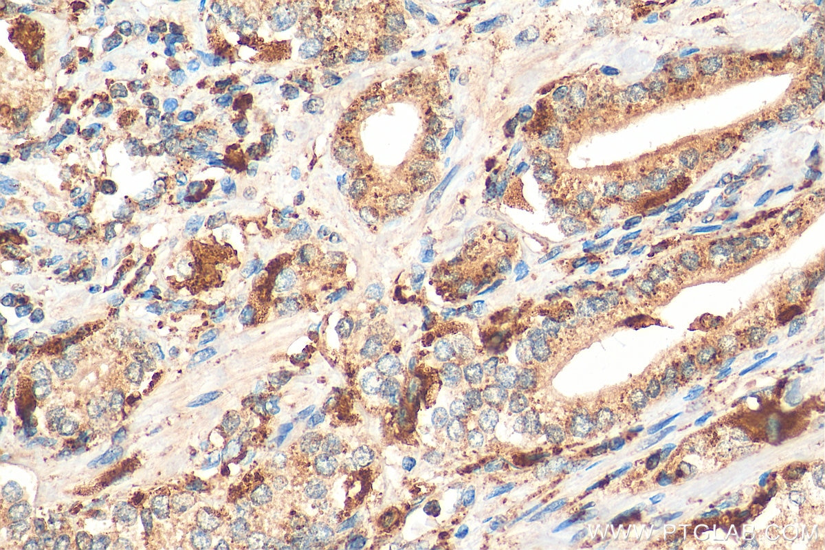 Immunohistochemistry (IHC) staining of human prostate cancer tissue using PSAP Polyclonal antibody (18397-1-AP)