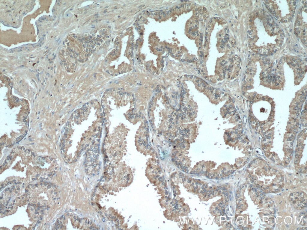 Immunohistochemistry (IHC) staining of human prostate cancer tissue using PSAP Polyclonal antibody (18397-1-AP)