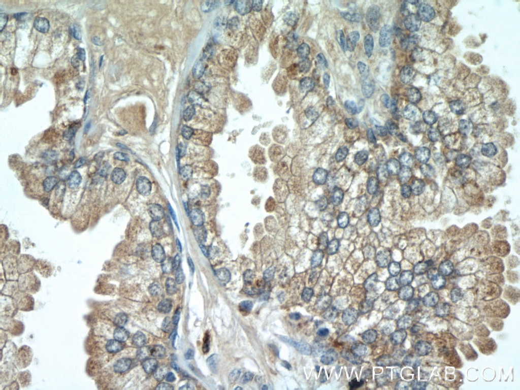 IHC staining of human prostate cancer using 18397-1-AP