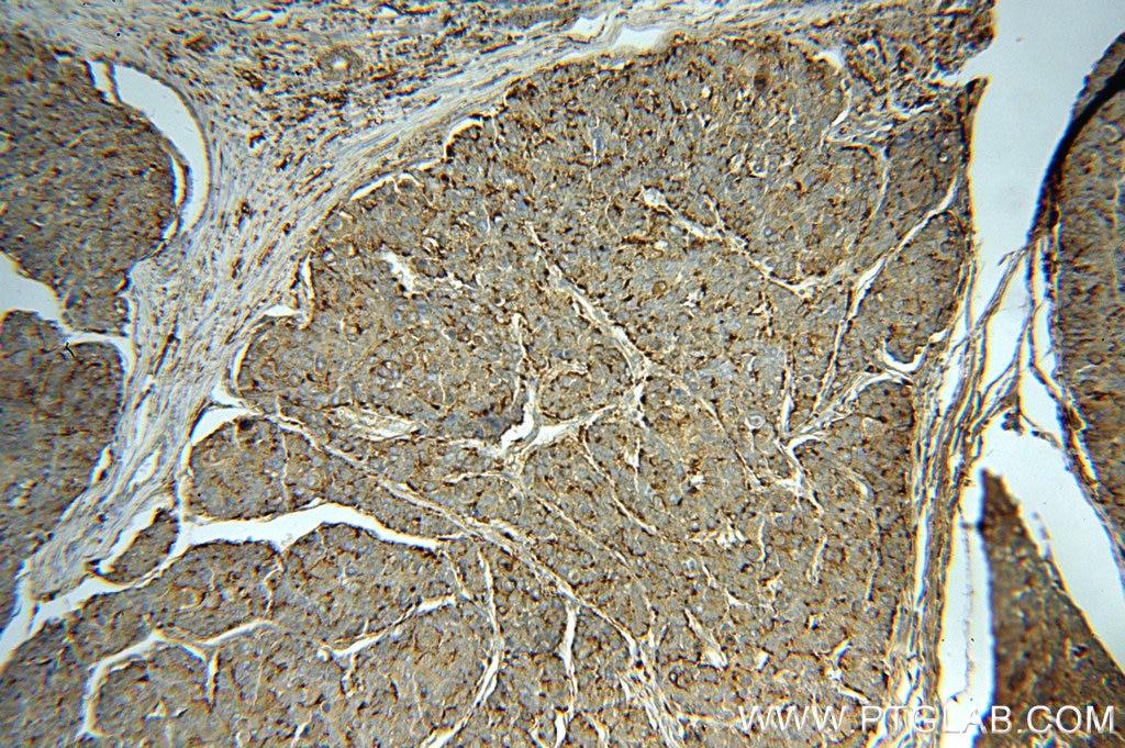 Immunohistochemistry (IHC) staining of human liver cancer tissue using PSAP Polyclonal antibody (18397-1-AP)