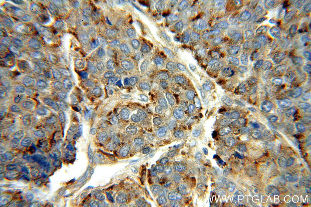 Immunohistochemistry (IHC) staining of human liver cancer tissue using PSAP Polyclonal antibody (18397-1-AP)