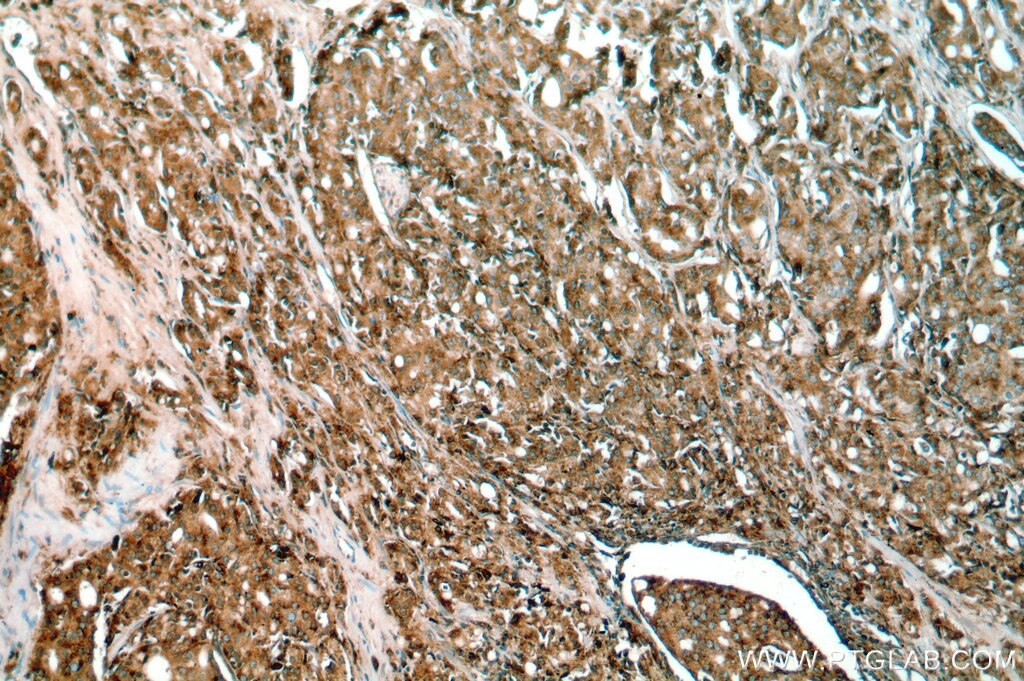 IHC staining of human prostate cancer using 18397-1-AP