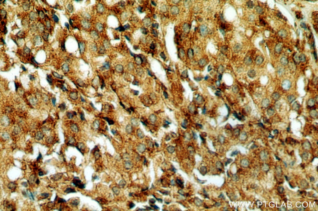 IHC staining of human prostate cancer using 18397-1-AP