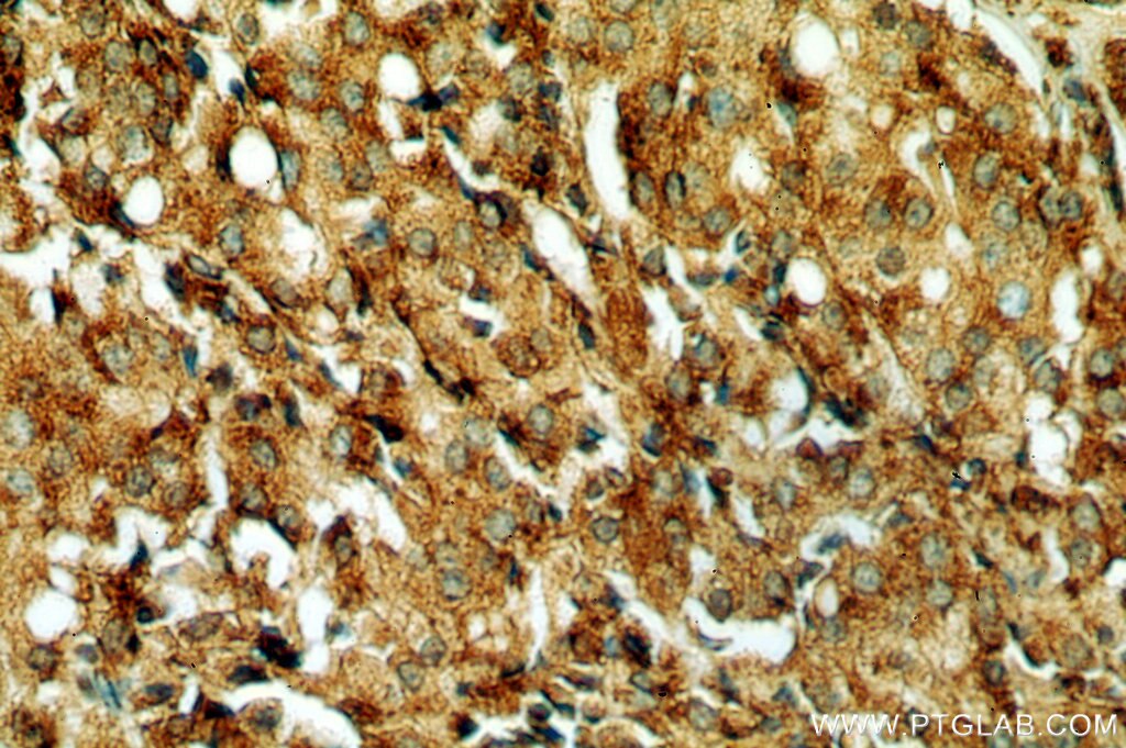 Immunohistochemistry (IHC) staining of human prostate cancer tissue using PSAP Polyclonal antibody (18397-1-AP)