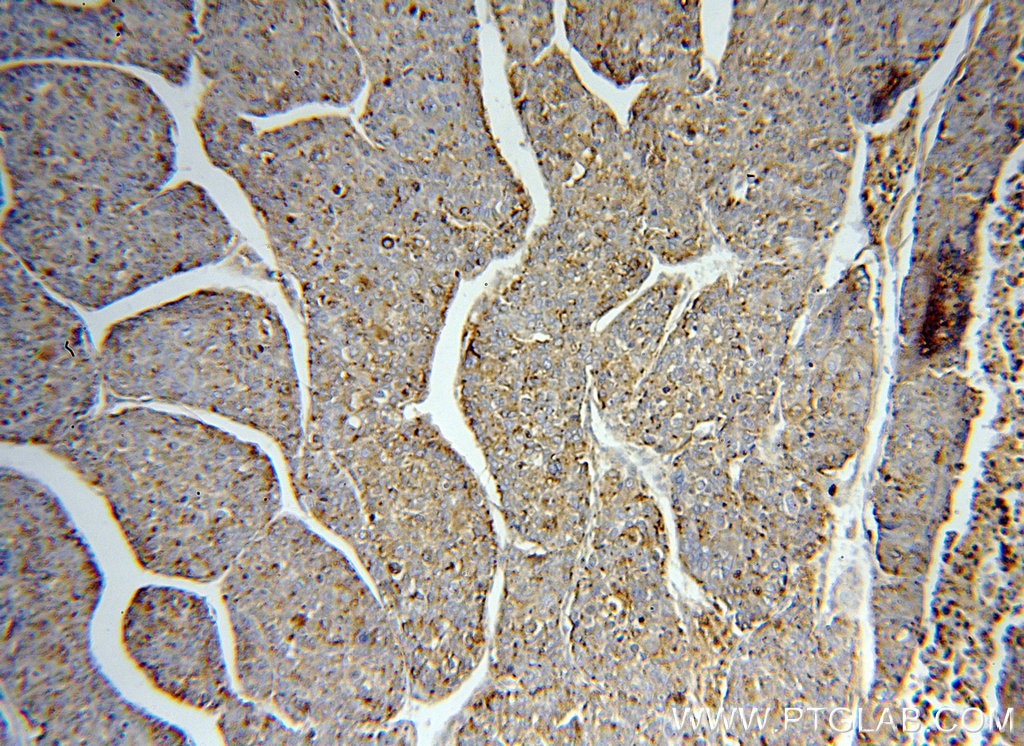 Immunohistochemistry (IHC) staining of human liver cancer tissue using PSAP Polyclonal antibody (18398-1-AP)