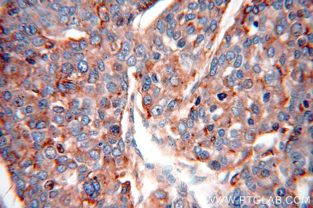 Immunohistochemistry (IHC) staining of human liver cancer tissue using PSAP Polyclonal antibody (18398-1-AP)