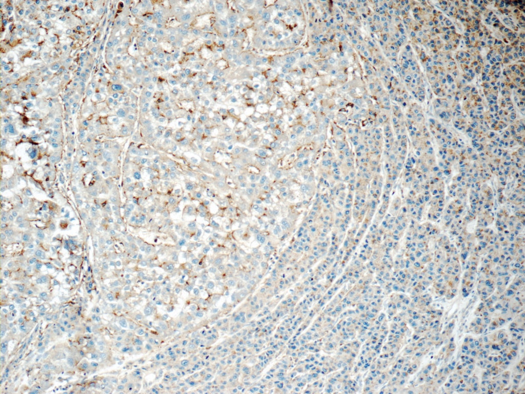 Immunohistochemistry (IHC) staining of human liver cancer tissue using PSAP Polyclonal antibody (18423-1-AP)