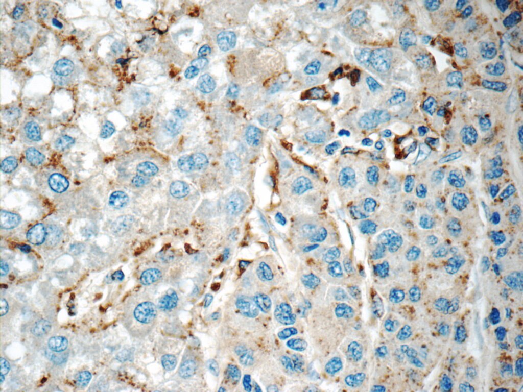 IHC staining of human liver cancer using 18423-1-AP