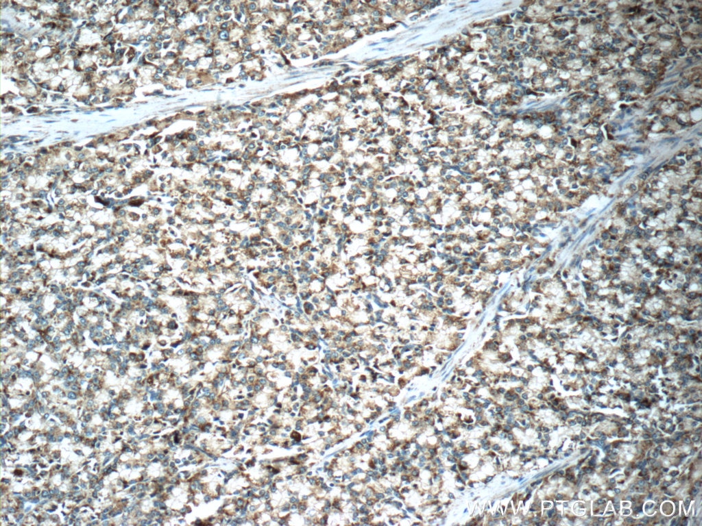 IHC staining of human prostate cancer using 18423-1-AP