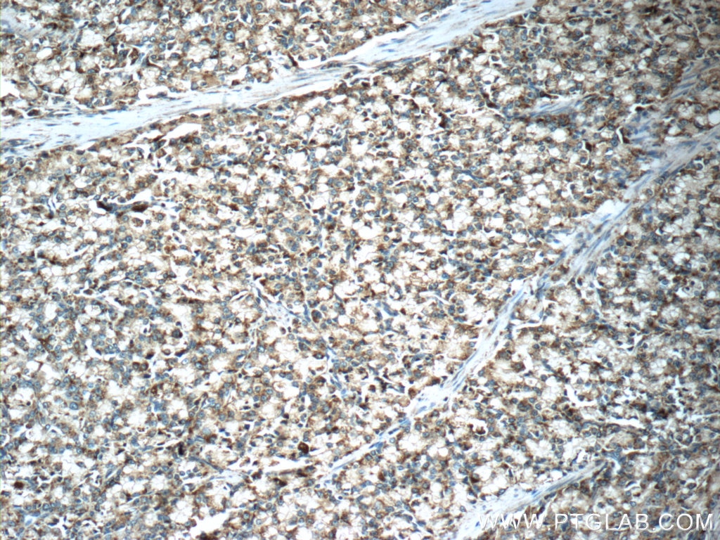 Immunohistochemistry (IHC) staining of human prostate cancer tissue using PSAP Polyclonal antibody (18423-1-AP)