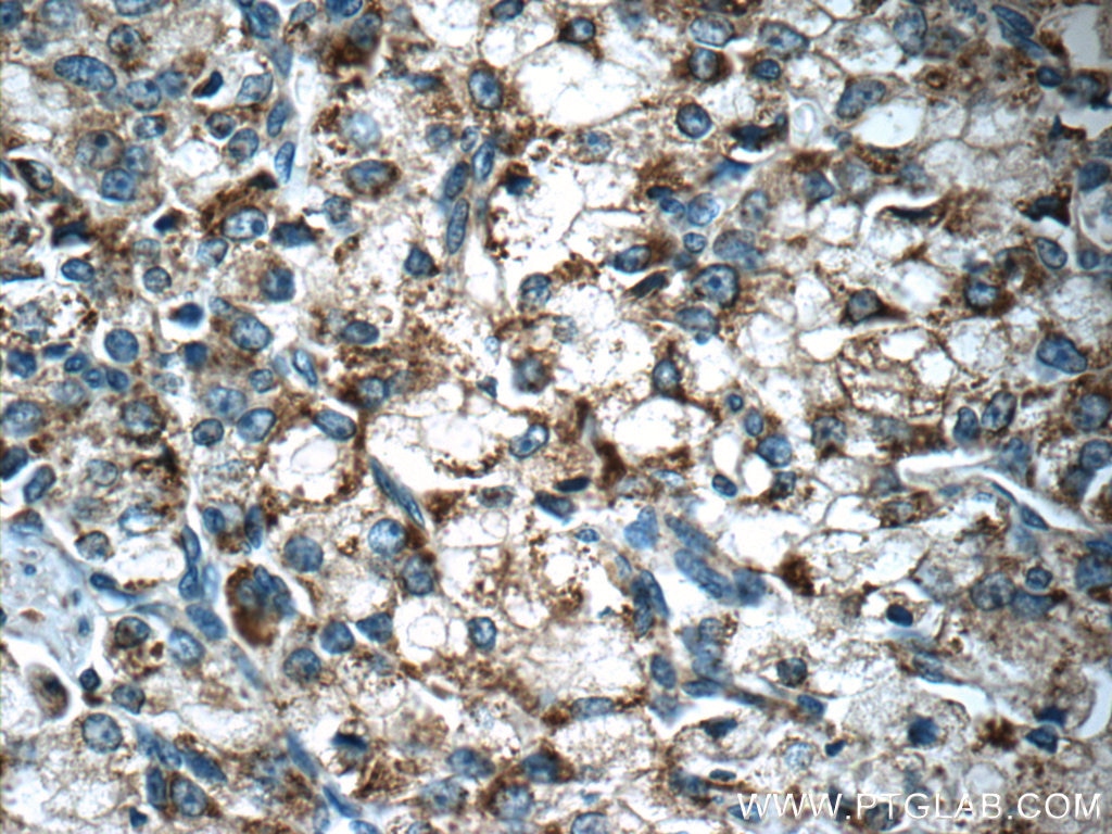 Immunohistochemistry (IHC) staining of human prostate cancer tissue using PSAP Polyclonal antibody (18423-1-AP)
