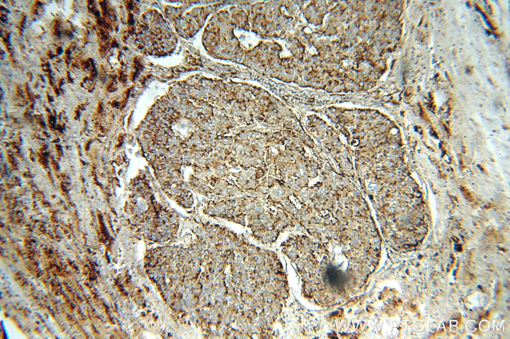 Immunohistochemistry (IHC) staining of human liver cancer tissue using PSAP Polyclonal antibody (18423-1-AP)