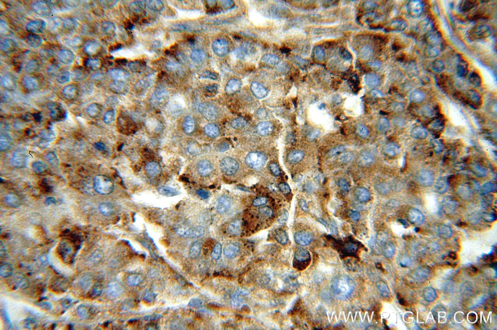 Immunohistochemistry (IHC) staining of human liver cancer tissue using PSAP Polyclonal antibody (18423-1-AP)