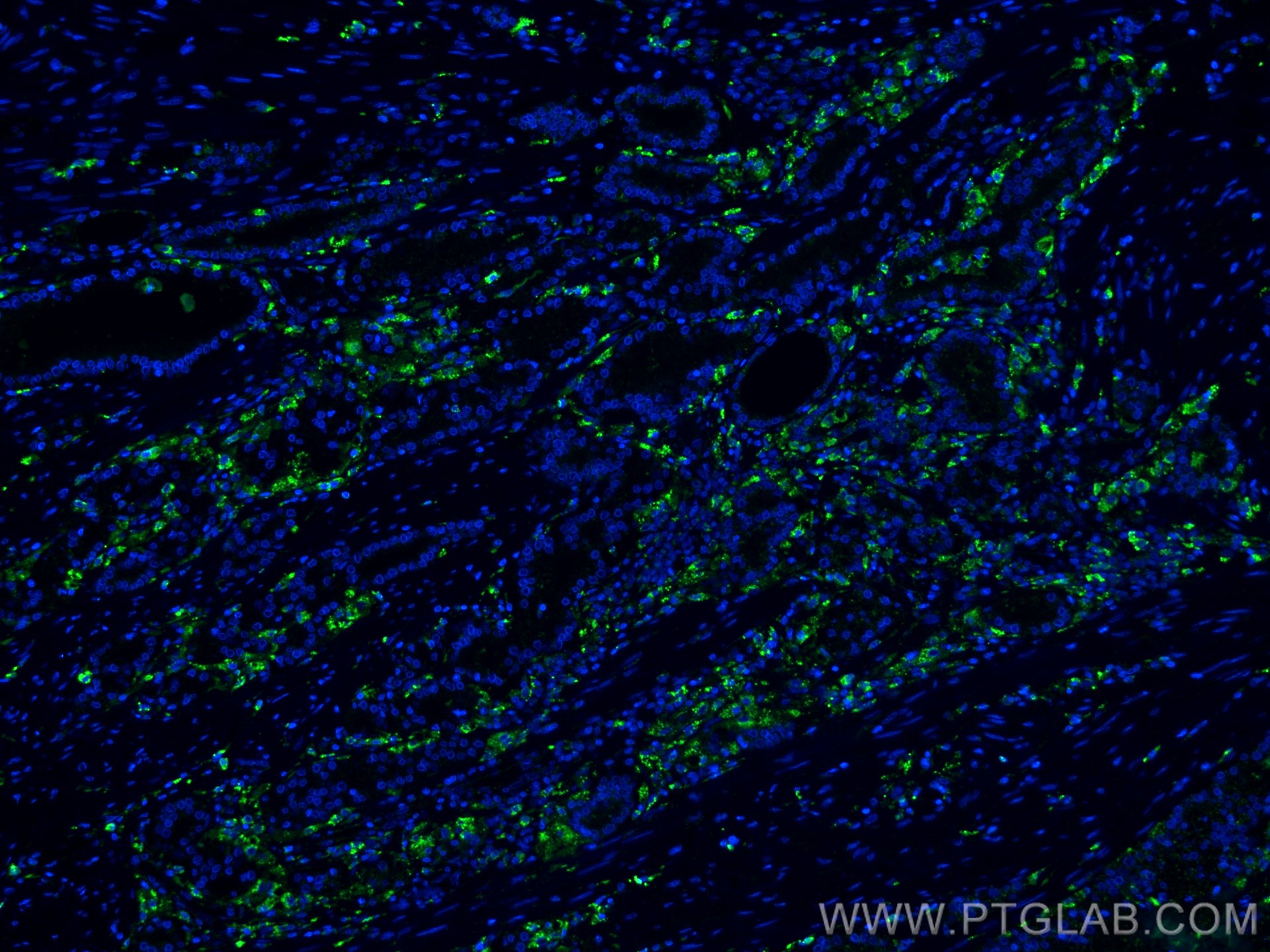 Immunofluorescence (IF) / fluorescent staining of human prostate cancer tissue using PSAP Monoclonal antibody (66473-1-Ig)