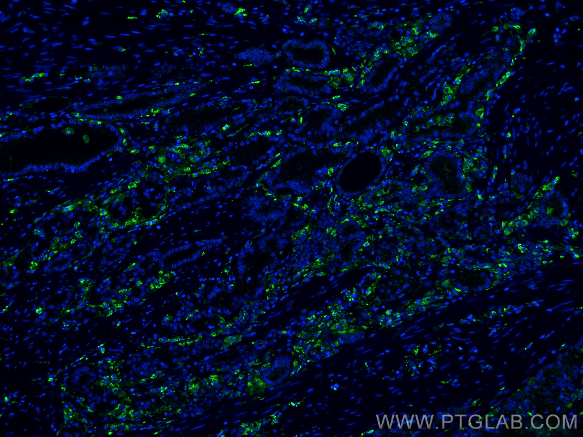 IF Staining of human prostate cancer using 66473-1-Ig