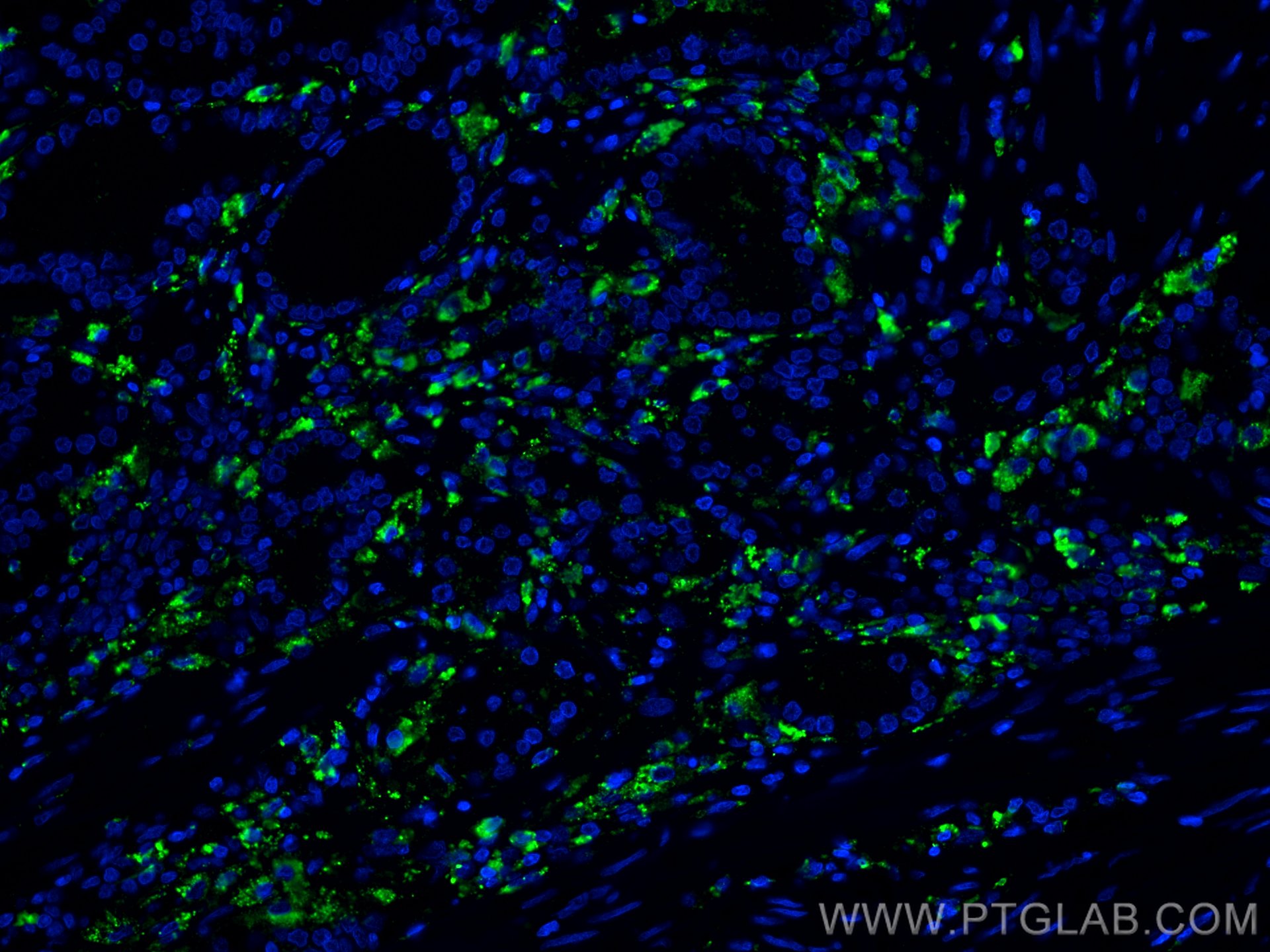 IF Staining of human prostate cancer using 66473-1-Ig