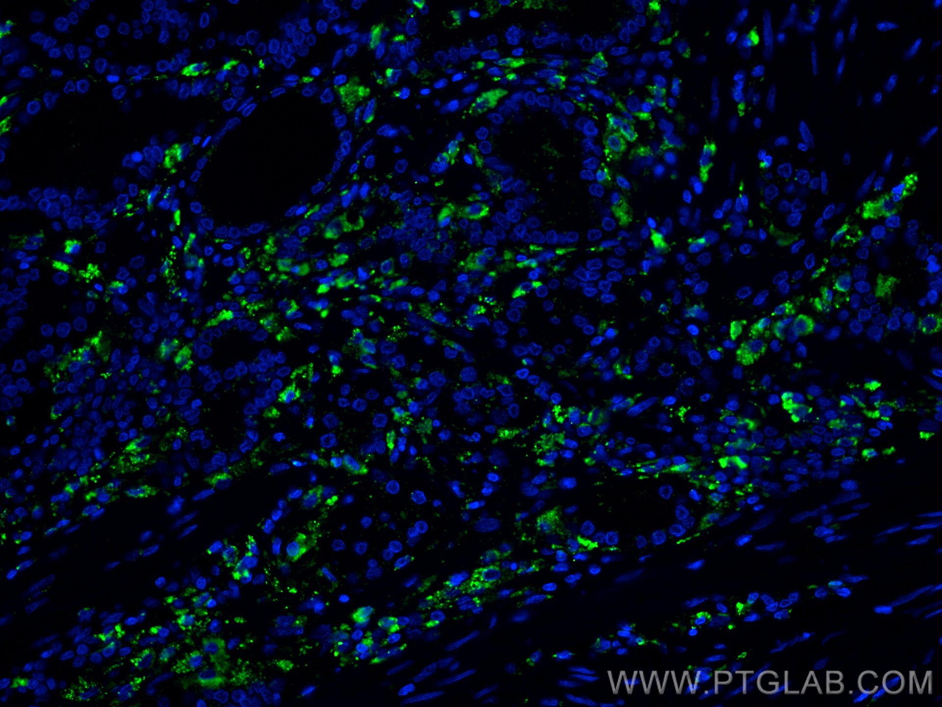 Immunofluorescence (IF) / fluorescent staining of human prostate cancer tissue using PSAP Monoclonal antibody (66473-1-Ig)