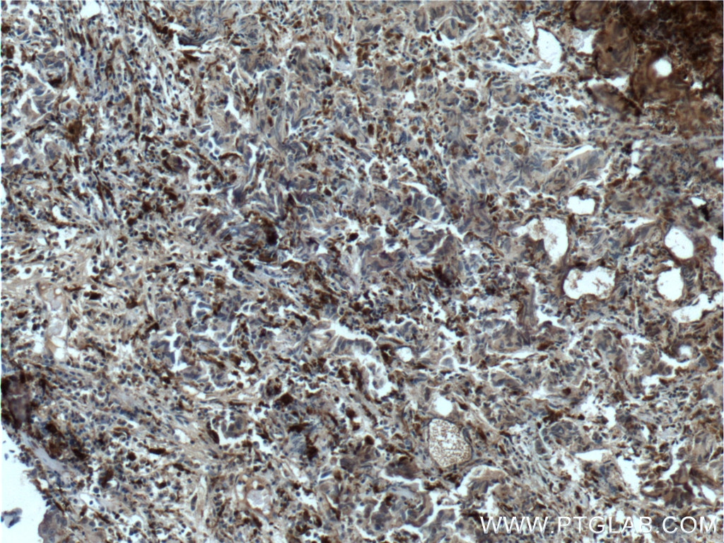 Immunohistochemistry (IHC) staining of human prostate cancer tissue using PSAP Monoclonal antibody (66473-1-Ig)