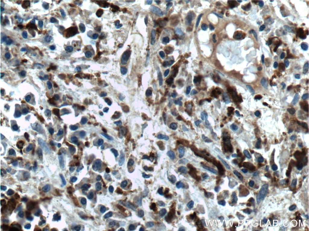 IHC staining of human prostate cancer using 66473-1-Ig