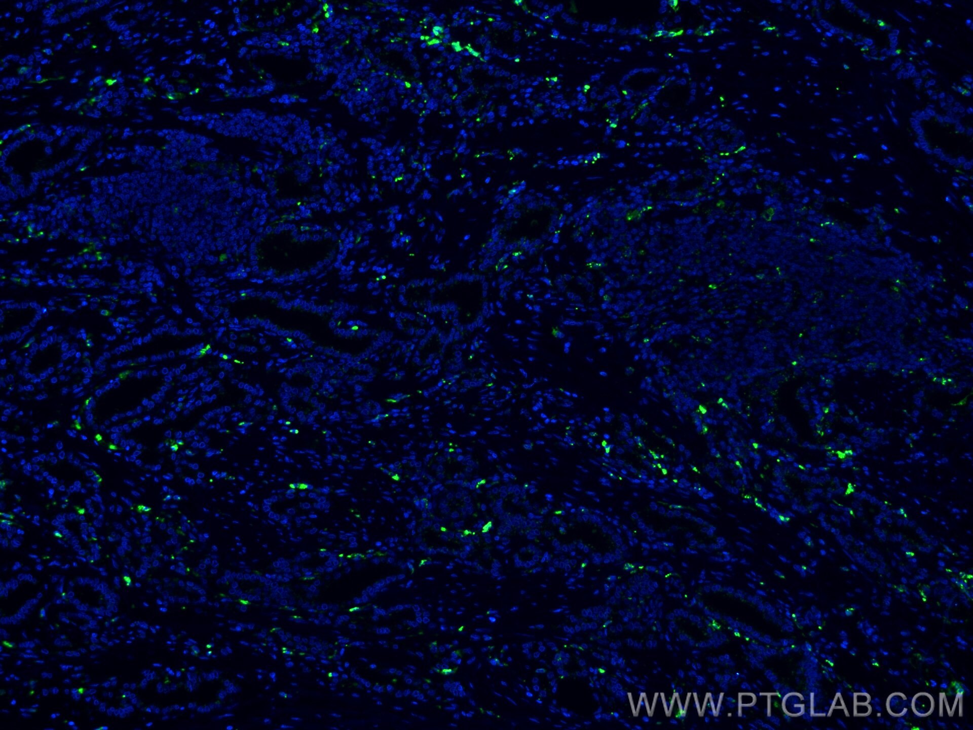 Immunofluorescence (IF) / fluorescent staining of human prostate cancer tissue using CoraLite® Plus 488-conjugated PSAP Monoclonal anti (CL488-66473)