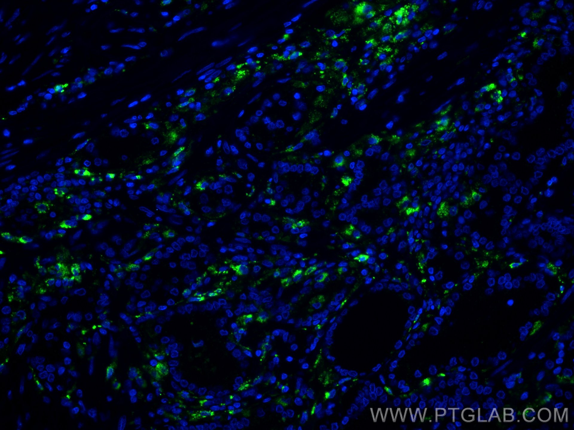 Immunofluorescence (IF) / fluorescent staining of human prostate cancer tissue using CoraLite® Plus 488-conjugated PSAP Monoclonal anti (CL488-66473)