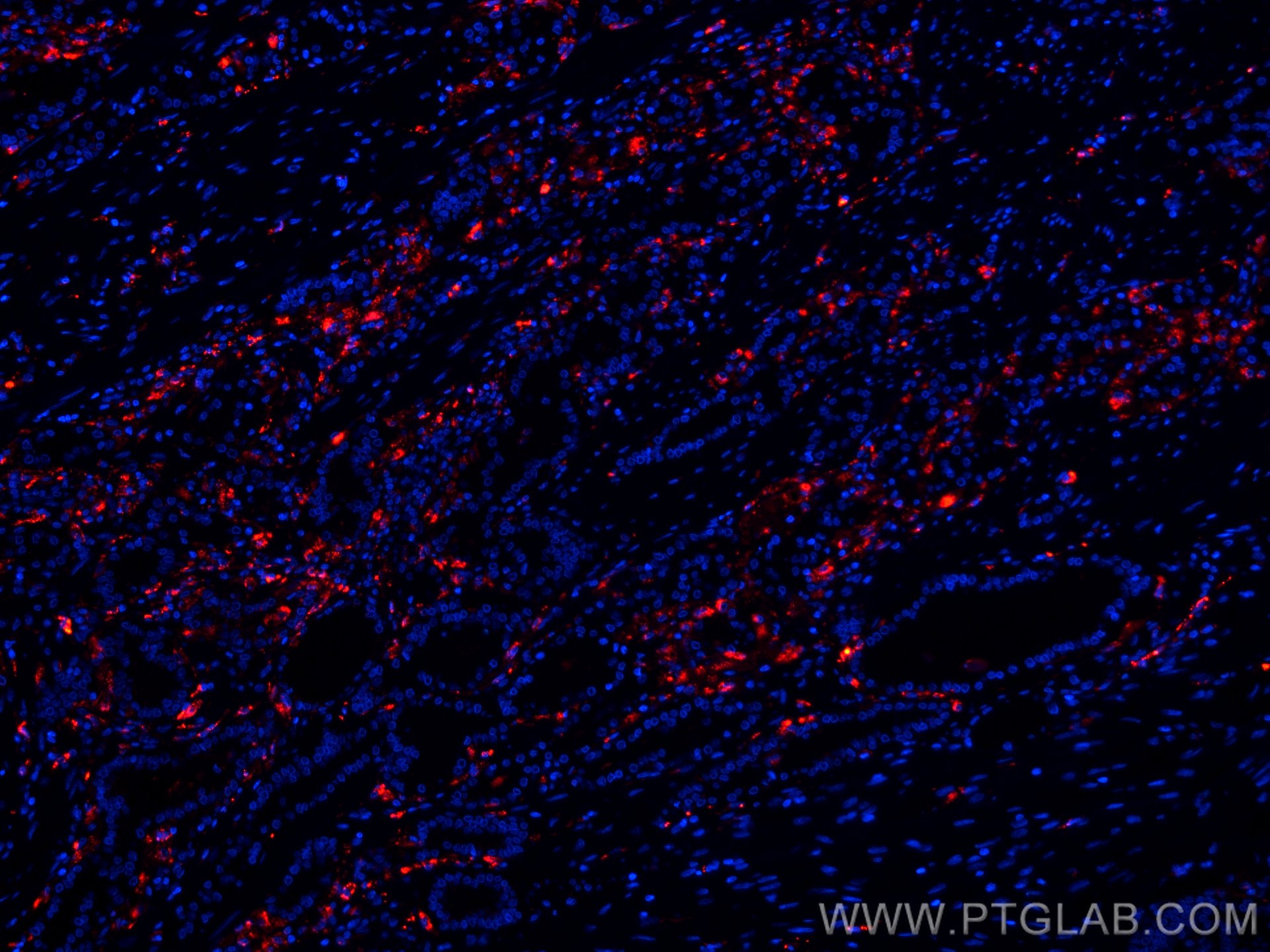 Immunofluorescence (IF) / fluorescent staining of human prostate cancer tissue using CoraLite®594-conjugated PSAP Monoclonal antibody (CL594-66473)