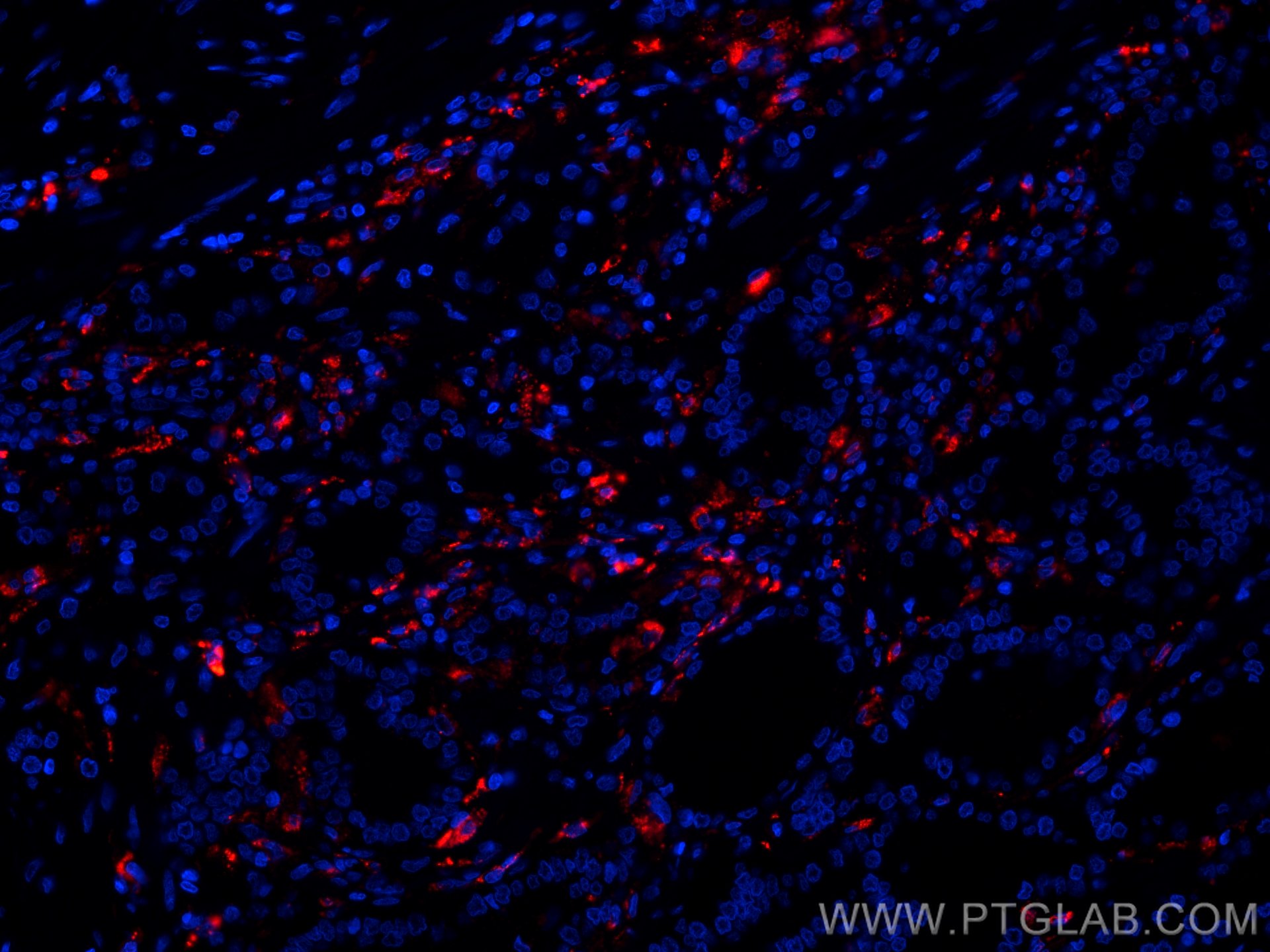 Immunofluorescence (IF) / fluorescent staining of human prostate cancer tissue using CoraLite®594-conjugated PSAP Monoclonal antibody (CL594-66473)