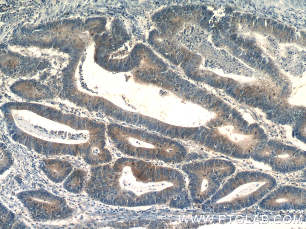 Immunohistochemistry (IHC) staining of human colon cancer tissue using PSAT1 Polyclonal antibody (10501-1-AP)