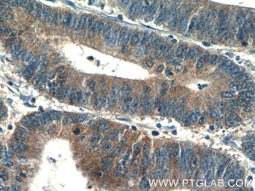 Immunohistochemistry (IHC) staining of human colon cancer tissue using PSAT1 Polyclonal antibody (10501-1-AP)