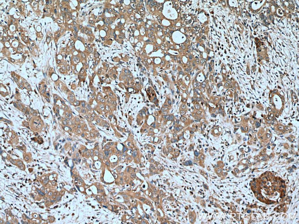 Immunohistochemistry (IHC) staining of human pancreas cancer tissue using PSAT1 Polyclonal antibody (10501-1-AP)