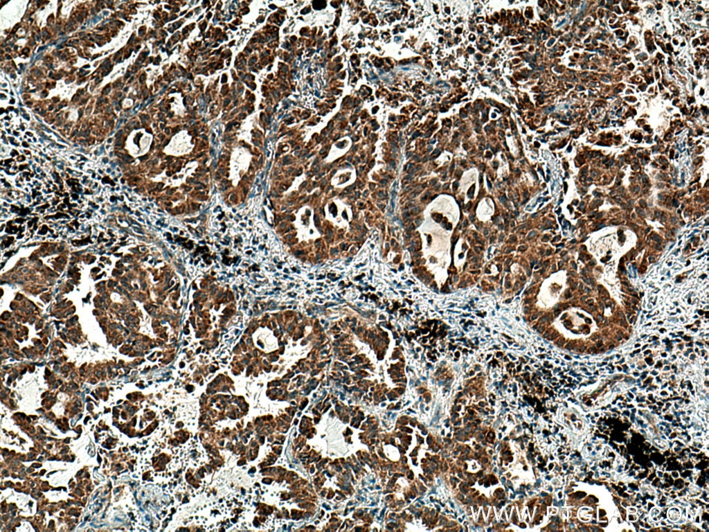 Immunohistochemistry (IHC) staining of human lung cancer tissue using PSAT1 Polyclonal antibody (20180-1-AP)