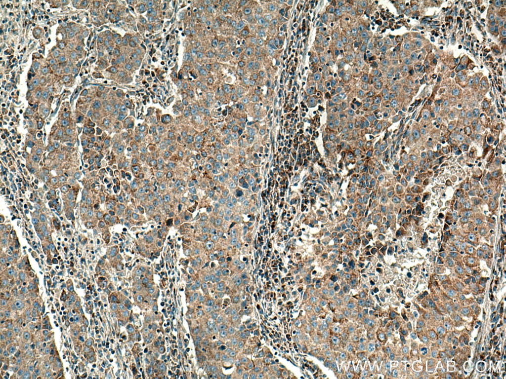 Immunohistochemistry (IHC) staining of human breast cancer tissue using PSAT1 Polyclonal antibody (20180-1-AP)