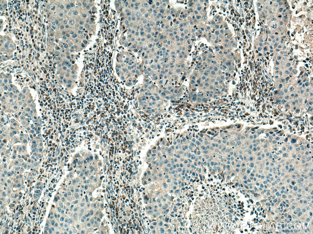 Immunohistochemistry (IHC) staining of human breast cancer tissue using PSAT1 Monoclonal antibody (67619-1-Ig)
