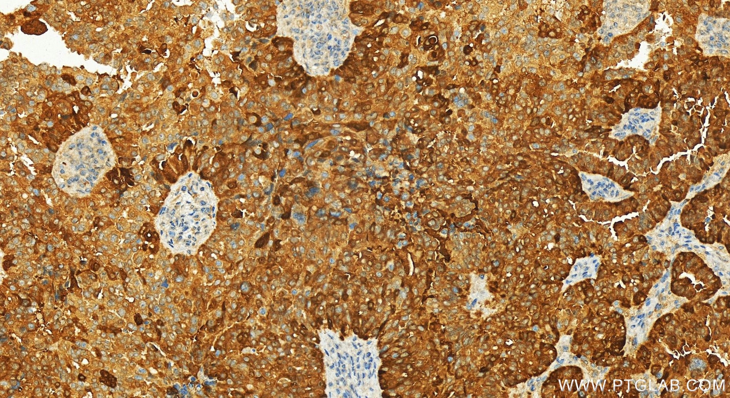 Immunohistochemical analysis of paraffin-embedded human ovarian cancer slide using 81479-1-RR (PSAT1 antibody) at dilution of 1:600 (under 20x lens). Heat mediated antigen retrieval with Tris-EDTA buffer (pH 9.0). Immunohistochemistry (IHC) staining of human ovarian cancer using PSAT1 Recombinant monoclonal antibody (81479-1-RR)