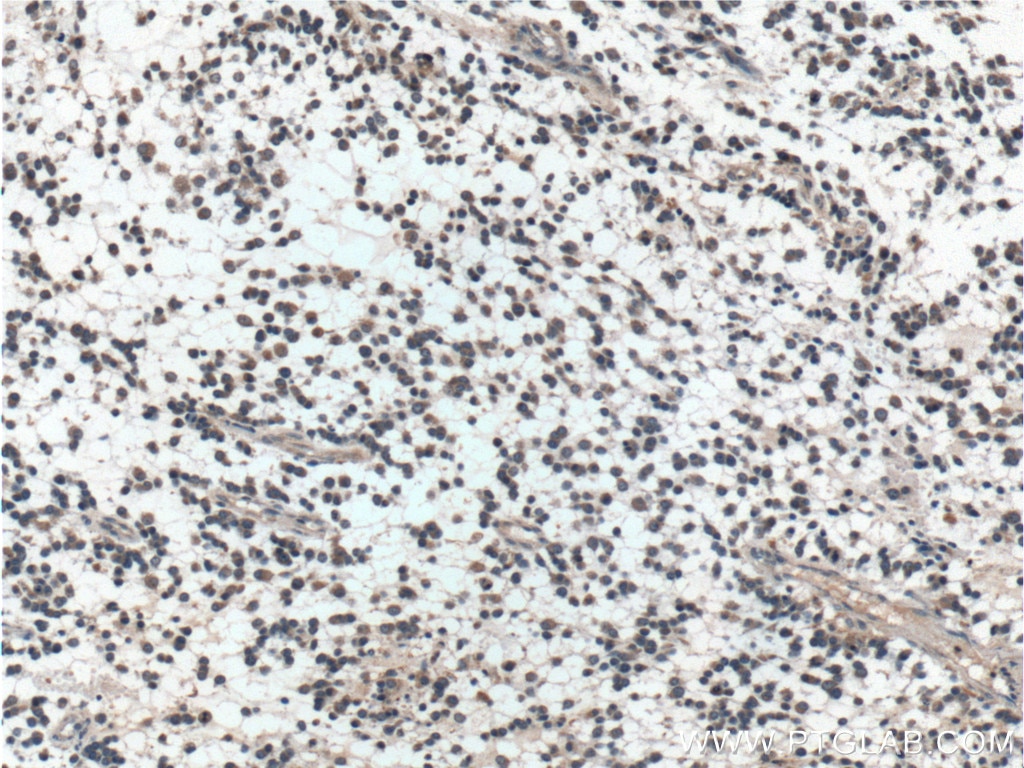 Immunohistochemistry (IHC) staining of human gliomas tissue using PSEN1 Polyclonal antibody (20434-1-AP)