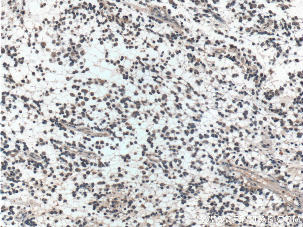 IHC staining of human gliomas using 20434-1-AP