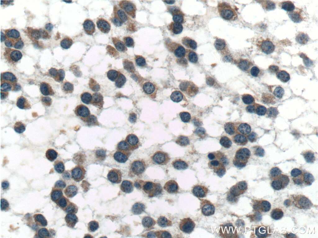 Immunohistochemistry (IHC) staining of human gliomas tissue using PSEN1 Polyclonal antibody (20434-1-AP)