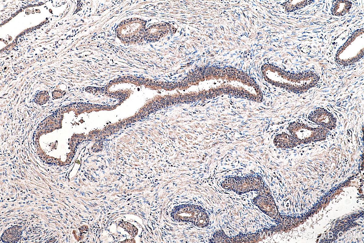 Immunohistochemistry (IHC) staining of human prostate cancer tissue using Presenilin-1-Specific Polyclonal antibody (16163-1-AP)