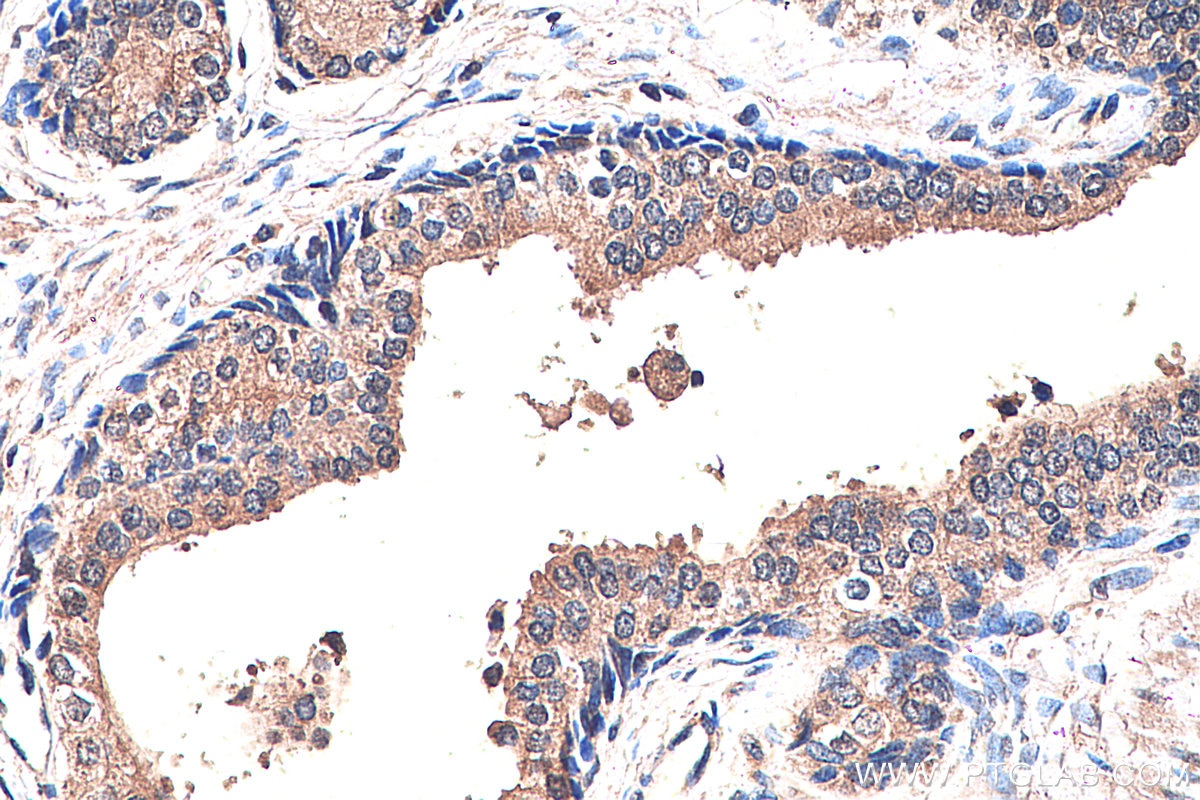IHC staining of human prostate cancer using 16163-1-AP