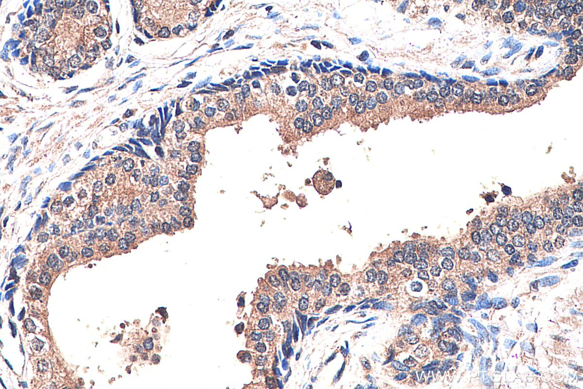 Immunohistochemistry (IHC) staining of human prostate cancer tissue using Presenilin-1-Specific Polyclonal antibody (16163-1-AP)