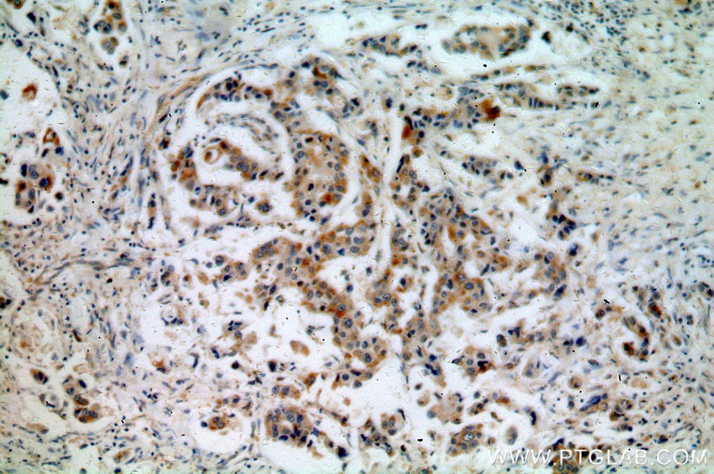 IHC staining of human breast cancer using 16168-1-AP