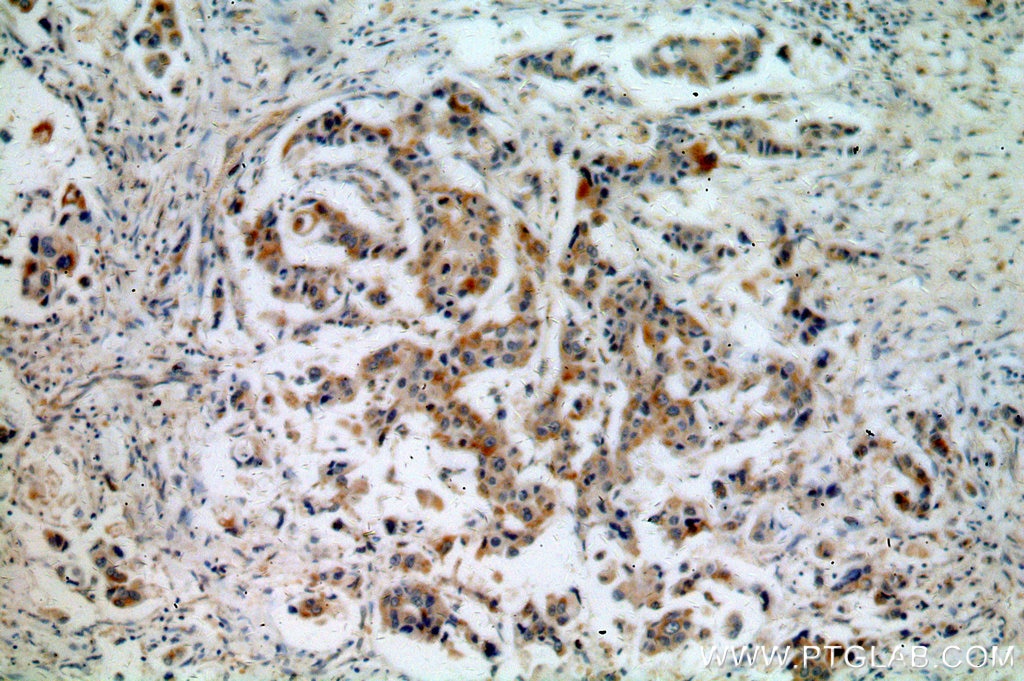 Immunohistochemistry (IHC) staining of human breast cancer tissue using PSEN2-Specific Polyclonal antibody (16168-1-AP)