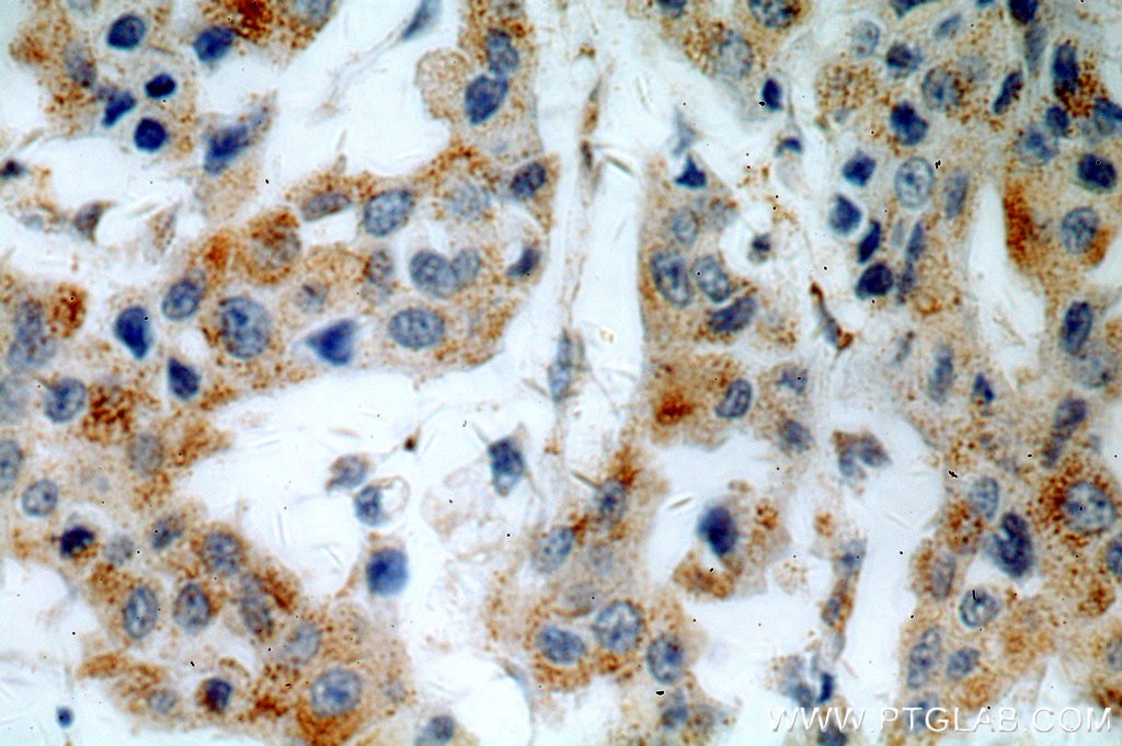 Immunohistochemistry (IHC) staining of human breast cancer tissue using PSEN2-Specific Polyclonal antibody (16168-1-AP)
