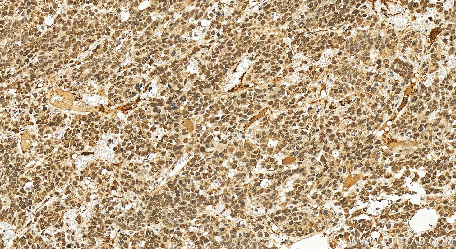 Immunohistochemical analysis of paraffin-embedded human hepatocellular carcinoma slide using 25504-1-AP (PSIP1/LEDGF antibody) at dilution of 1:800 (under 20x lens). Heat mediated antigen retrieval with Tris-EDTA buffer (pH 9.0). Immunohistochemistry (IHC) staining of human hepatocellular carcinoma using PSIP1 Polyclonal antibody (25504-1-AP)