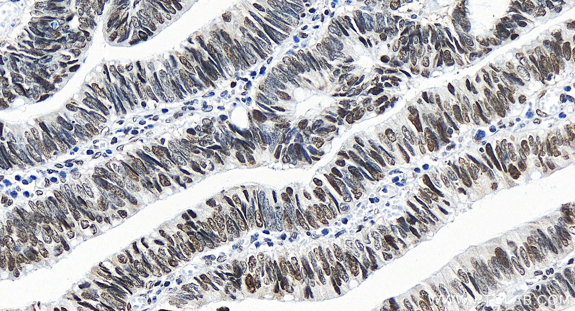 Immunohistochemistry (IHC) staining of human colon cancer tissue using PSIP1 Recombinant antibody (85395-1-RR)