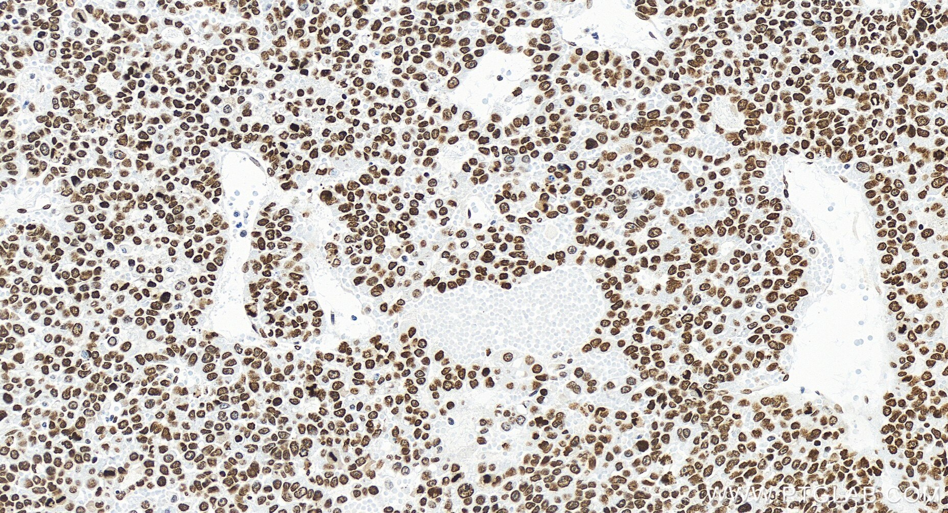 Immunohistochemistry (IHC) staining of human liver cancer tissue using PSIP1 Recombinant antibody (85395-1-RR)