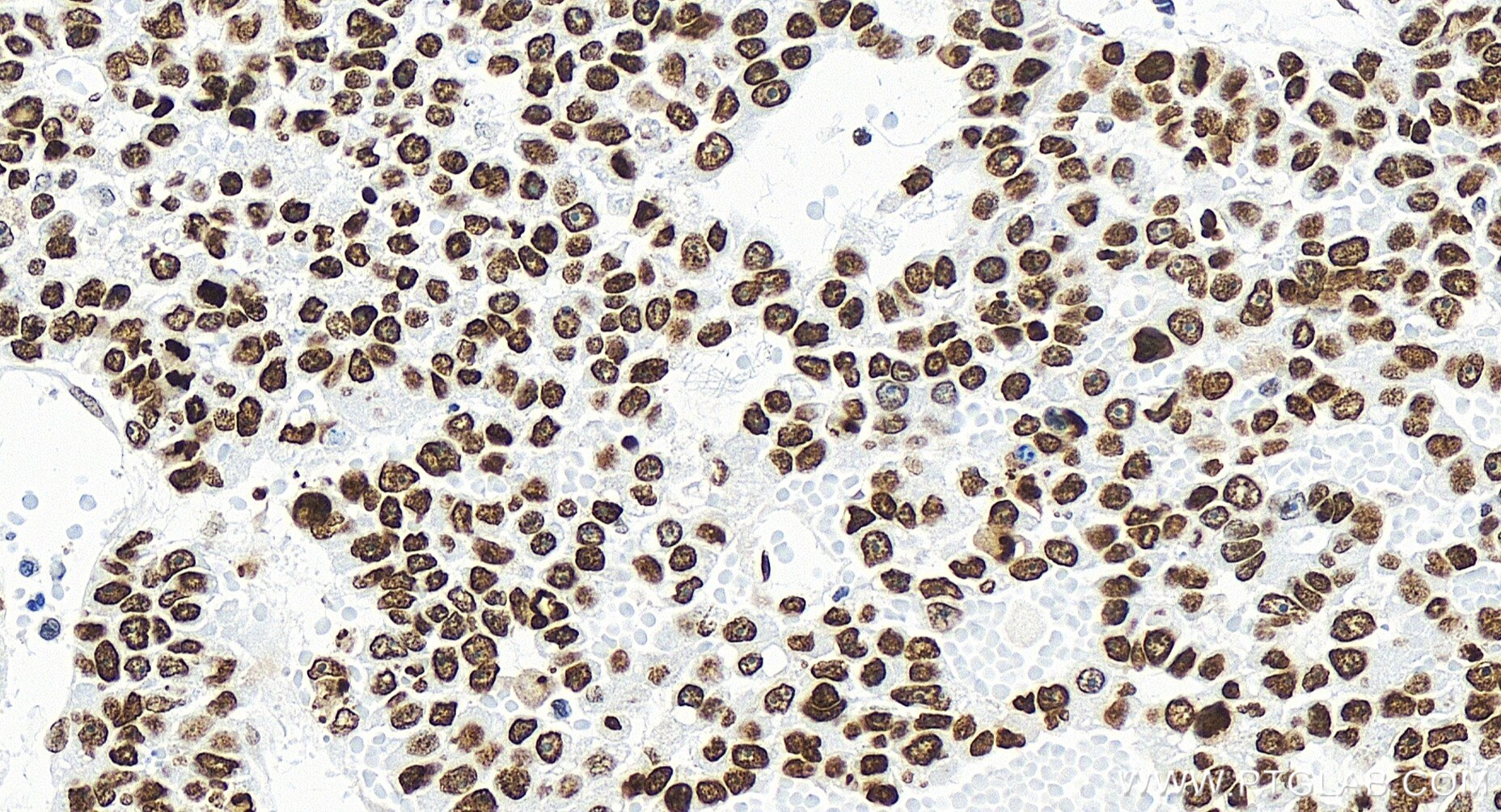 Immunohistochemistry (IHC) staining of human liver cancer tissue using PSIP1 Recombinant antibody (85395-1-RR)