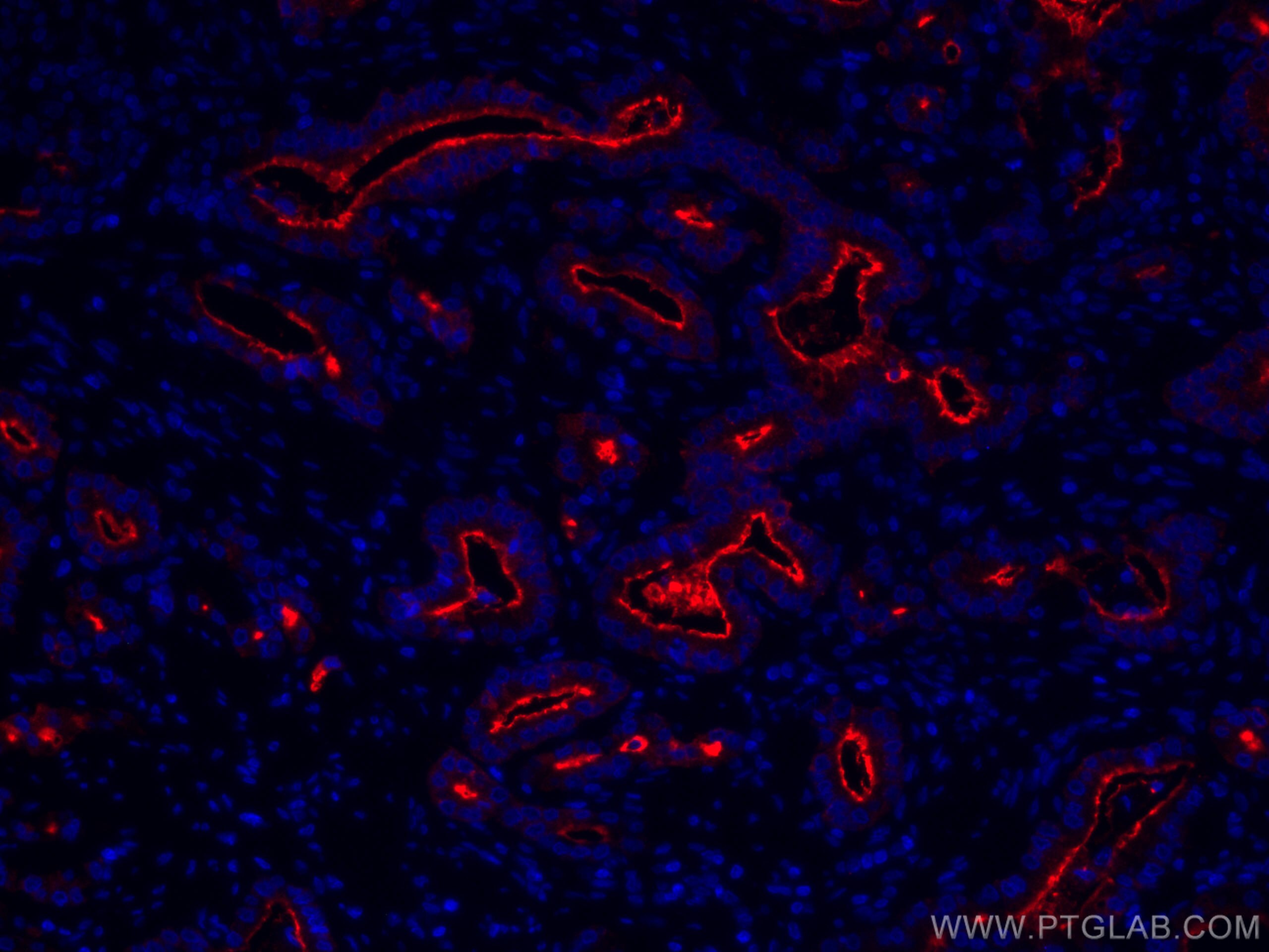Immunofluorescence (IF) / fluorescent staining of human prostate cancer tissue using CoraLite®594-conjugated PSMA/GCPII Monoclonal anti (CL594-66678)